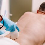 Pilonidal Abscess laser hair removal treatment