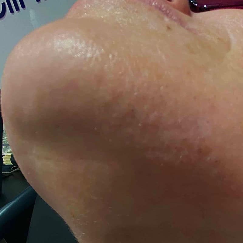 Before – chin area