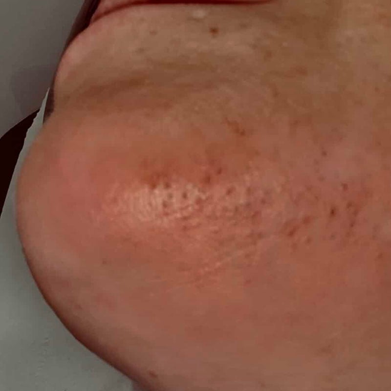 After 1st Treatment – chin area