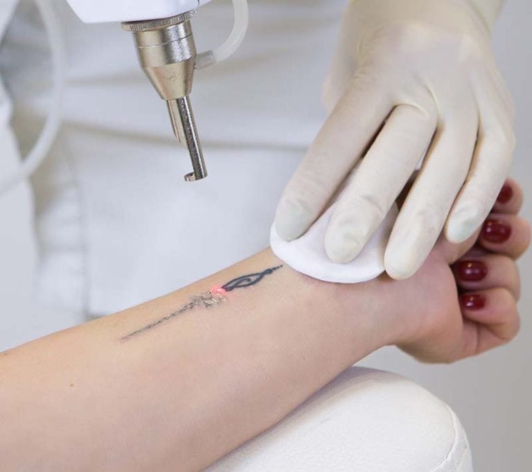 laser tattoo removal on the arm