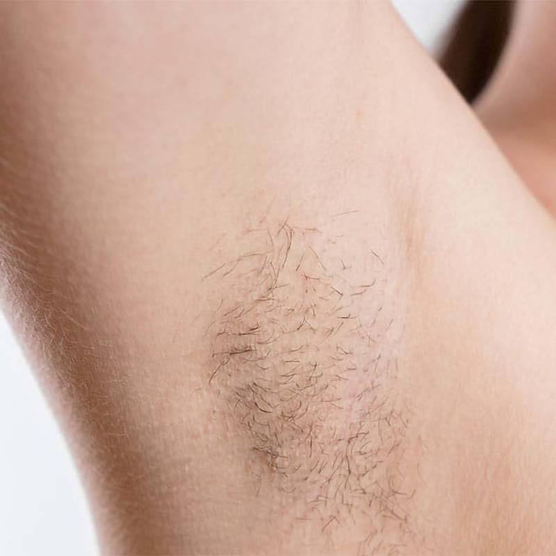 After Treatment – underarms