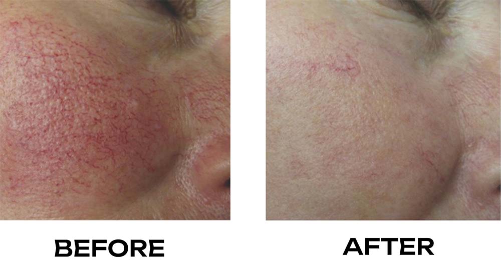 Rosacea before and after treatment photo