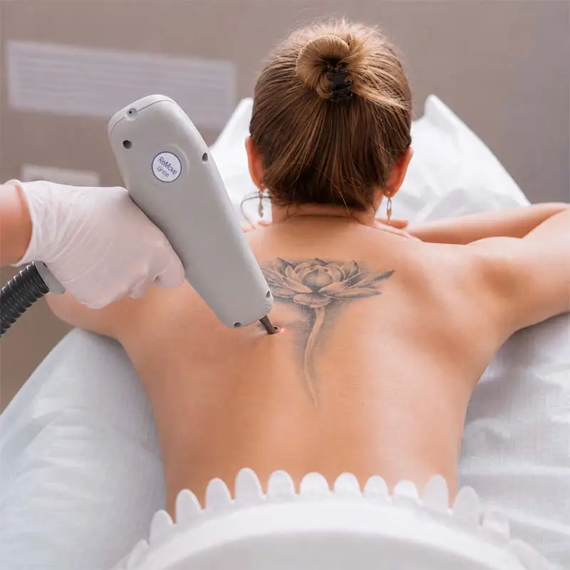Laser Tattoo Removal Devon